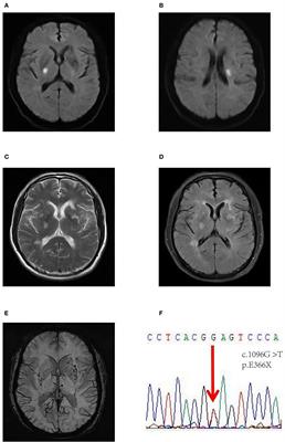 Case report: Two unique nonsense mutations in HTRA1-related cerebral small vessel disease in a Chinese population and literature review